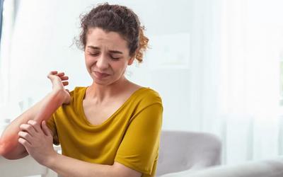 Dermatite atópica pode afetar negativamente a saúde mental